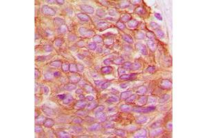Immunohistochemical analysis of Gamma-catenin staining in human breast cancer formalin fixed paraffin embedded tissue section.