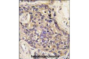 Formalin-fixed and paraffin-embedded human hepatocarcinoma tissue reacted with HGF antibody , which was peroxidase-conjugated to the secondary antibody, followed by DAB staining. (HGF antibody  (C-Term))