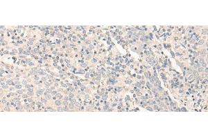 Immunohistochemistry of paraffin-embedded Human cervical cancer tissue using RADIL Polyclonal Antibody at dilution of 1:40(x200) (Radil antibody)