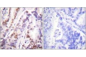 Immunohistochemistry analysis of paraffin-embedded human lung carcinoma tissue, using HDAC9 Antibody. (HDAC9 antibody  (AA 1017-1066))