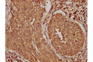 IHC image of ABIN7159477 diluted at 1:100 and staining in paraffin-embedded human cervical cancer performed on a Leica BondTM system. (TRABD2B antibody  (AA 195-405))