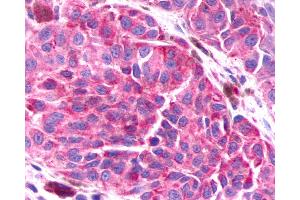 Anti-BAI3 antibody IHC of human Skin, Melanoma. (BAI3 antibody  (Cytoplasmic Domain))