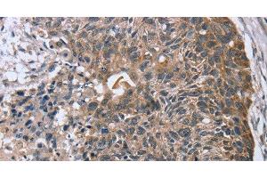 Immunohistochemistry of paraffin-embedded Human esophagus cancer using RASSF7 Polyclonal Antibody at dilution of 1:45 (RASSF7 antibody)