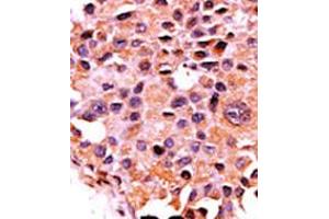 Formalin-fixed and paraffin-embedded human cancer tissue reacted with the primary antibody, which was peroxidase-conjugated to the secondary antibody, followed by AEC staining. (CAN antibody  (N-Term))