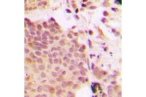 Immunohistochemical analysis of G3BP1 (pS232) staining in human breast cancer formalin fixed paraffin embedded tissue section. (G3BP1 antibody  (pSer232))