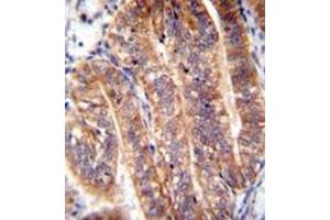 Immunohistochemistry analysis in formalin fixed and paraffin embedded human uterus tissue reacted with NUMB Antibody (N-term) followed by peroxidase conjugation of the secondary antibody and DAB staining. (NUMB antibody  (N-Term))