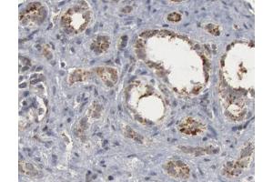 1/50 dilution staining Caspase 9 in human lung carcinoma by Immunohistochemistry (Caspase 9 antibody  (Cleaved-Asp330))