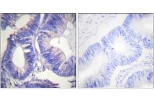 Immunohistochemistry analysis of paraffin-embedded human colon carcinoma tissue, using NCK2 Antibody. (NCK2 antibody  (AA 331-380))