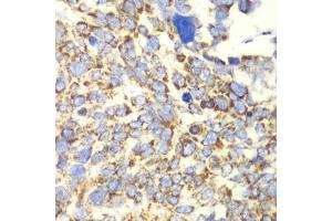 Immunohistochemistry of paraffin-embedded human esophageal cancer using GLUD2 antibody. (GLUD2 antibody)