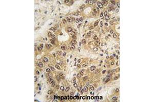 Formalin-fixed and paraffin-embedded human hepatocellular carcinoma tissue reacted with ZIC3 polyclonal antibody , which was peroxidase-conjugated to the secondary antibody, followed by DAB staining. (ZIC3 antibody  (N-Term))