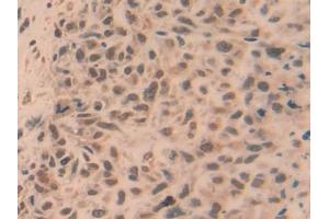 Detection of TRAF5 in Human Lung cancer Tissue using Polyclonal Antibody to TNF Receptor Associated Factor 5 (TRAF5) (TRAF5 antibody  (AA 181-437))