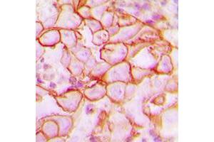 Immunohistochemical analysis of CD61 staining in human breast cancer formalin fixed paraffin embedded tissue section.