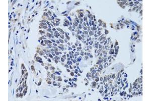 Immunohistochemistry of paraffin-embedded human lung cancer using SIN3A antibody (ABIN6293567) at dilution of 1:100 (40x lens). (SIN3A antibody)