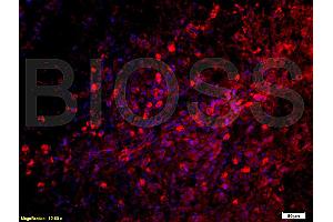 Formalin-fixed and paraffin embedded: Human laryngeal carcinoma labeled with Anti-C5a Polyclonal Antibody (ABIN727875), Unconjugated at 1:200, followed by conjugation to the secondary antibody was Goat Anti-Rabbit IgG, PE conjugated at 1:200 for 40 minutes at 37°C (C5 antibody  (AA 701-755))