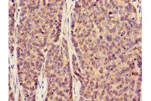 Immunohistochemistry of paraffin-embedded human ovarian cancer using ABIN7170002 at dilution of 1:100 (GLUT1 antibody  (AA 263-458))