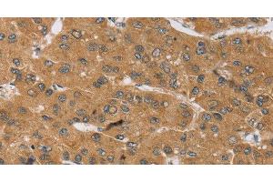 Immunohistochemistry of paraffin-embedded Human liver cancer tissue using KCNJ15 Polyclonal Antibody at dilution 1:40 (KCNJ15 antibody)