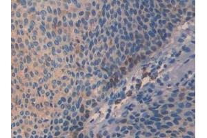 Detection of Slit3 in Human Skin cancer Tissue using Polyclonal Antibody to Slit Homolog 3 (Slit3) (SLIT3 antibody  (AA 1405-1512))