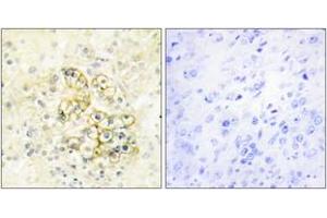 Immunohistochemistry analysis of paraffin-embedded human prostate tissue, using TMEPA Antibody. (TMEPA (AA 101-150) antibody)