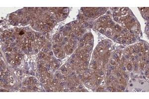 ABIN6273973 at 1/100 staining Human liver cancer tissue by IHC-P. (OR1L3 antibody  (C-Term))