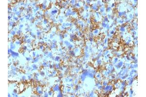 Formalin-fixed, paraffin-embedded human Histiocytoma stained with HLA-DR Monoclonal Antibody (LN-3). (HLA-DRB1 antibody)