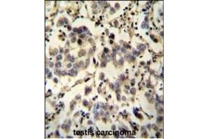 C6orf58 antibody (Center) (ABIN653979 and ABIN2843925) immunohistochemistry analysis in formalin fixed and paraffin embedded human testis carcinoma followed by peroxidase conjugation of the secondary antibody and DAB staining. (C6ORF58 antibody  (AA 205-233))