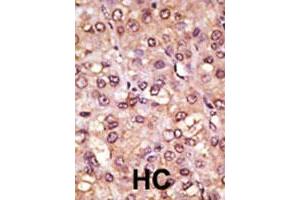 Formalin-fixed and paraffin-embedded human hepatocellular carcinoma tissue reacted with ASCL1 polyclonal antibody , which was peroxidase-conjugated to the secondary antibody, followed by AEC staining. (ASCL1 antibody  (C-Term))