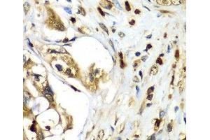 Immunohistochemistry of paraffin-embedded Human liver cancer using TMOD4 Polyclonal Antibody at dilution of 1:100 (40x lens). (Tropomodulin 4 antibody)