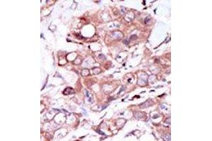 Formalin-fixed and paraffin-embedded human cancer tissue reacted with the primary antibody, which was peroxidase-conjugated to the secondary antibody, followed by DAB staining. (ERBB4 antibody  (C-Term))