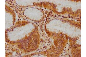 IHC image of ABIN7139891 diluted at 1:100 and staining in paraffin-embedded human gastric cancer performed on a Leica BondTM system. (IFNA5 antibody  (AA 52-73))