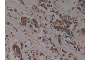 DAB staining on IHC-P; Samples: Human Breast cancer Tissue (PSMC6 antibody  (AA 2-403))