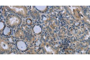 Immunohistochemistry of paraffin-embedded Human thyroid cancer tissue using EGFL8 Polyclonal Antibody at dilution 1:40