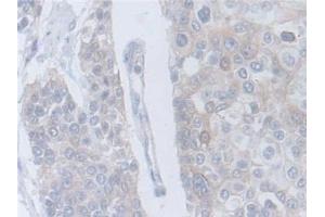 Detection of CRLF1 in Human Prostate cancer Tissue using Polyclonal Antibody to Cytokine Receptor Like Factor 1 (CRLF1) (CRLF1 antibody  (AA 138-422))