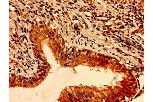Immunohistochemistry of paraffin-embedded human lung cancer using ABIN7172475 at dilution of 1:100 (TFAP2C antibody  (AA 8-180))