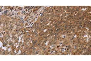 Immunohistochemistry of paraffin-embedded Human cervical cancer using NDUFS2 Polyclonal Antibody at dilution of 1:35