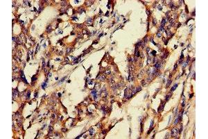 Immunohistochemistry of paraffin-embedded human gastric cancer using ABIN7153675 at dilution of 1:100 (Gastrin-Releasing Peptide antibody  (AA 31-98))