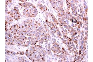 IHC-P Image PDCD6 antibody detects PDCD6 protein at cytoplasm on human colon carcinoma by immunohistochemical analysis.