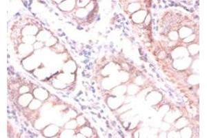 Immunohistochemistry of paraffin-embedded human colon cancer using ABIN7147238 at dilution of 1:100 (CDKN2AIPNL antibody  (N-Term))