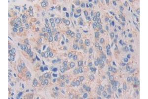 DAB staining on IHC-P; Samples: Human Prostate cancer Tissue (IL-37 antibody  (AA 46-218))
