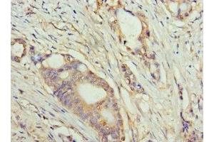 Immunohistochemistry of paraffin-embedded human colon cancer using ABIN7159633 at dilution of 1:100 (TET1 antibody  (AA 1700-1800))