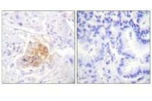 Immunohistochemistry analysis of paraffin-embedded human lung carcinoma tissue using IL-2Rβ/CD122 (Ab-364) antibody. (IL2 Receptor beta antibody  (Tyr364))