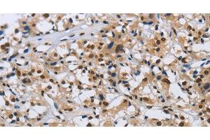 Immunohistochemistry of paraffin-embedded Human thyroid cancer tissue using KPNB1 Polyclonal Antibody at dilution 1:40 (KPNB1 antibody)