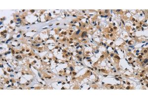Immunohistochemistry of paraffin-embedded Human thyroid cancer tissue using KPNB1 Polyclonal Antibody at dilution 1:40