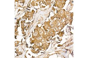 Immunohistochemistry of paraffin-embedded human breast cancer using β-Catenin Rabbit mAb (ABIN7266138) at dilution of 1:50 (40x lens). (CTNNB1 antibody)