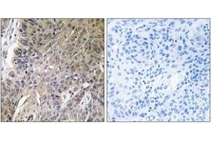 Immunohistochemistry analysis of paraffin-embedded human lung carcinoma tissue, using ARSG Antibody. (ARSG antibody  (AA 251-300))