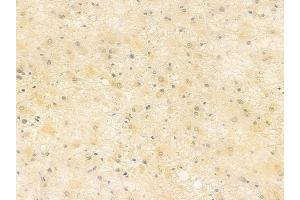 ABIN6257606 and ABIN6275142 at 1/100 staining human astrocytoma by IHC-P.