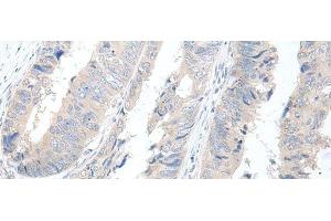 Immunohistochemistry of paraffin-embedded Human colorectal cancer tissue using GBA2 Polyclonal Antibody at dilution of 1:55(x200) (GBA2 antibody)