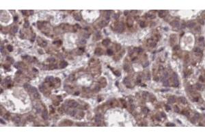 ABIN6273910 at 1/100 staining Human liver cancer tissue by IHC-P. (SSTR5 antibody  (Internal Region))