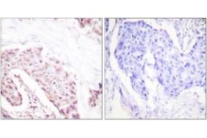 Immunohistochemistry analysis of paraffin-embedded human breast carcinoma, using Akt (Phospho-Ser124) Antibody. (AKT1 antibody  (pSer124))