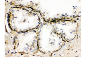 TRPM5 was detected in paraffin-embedded sections of human prostatic cancer tissues using rabbit anti- TRPM5 Antigen Affinity purified polyclonal antibody at 1 μg/mL. (TRPM5 antibody  (AA 1021-1108))
