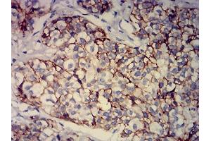 Immunohistochemical analysis of paraffin-embedded bladder cancer tissues using CD239 mouse mAb with DAB staining. (BCAM antibody  (AA 32-197))